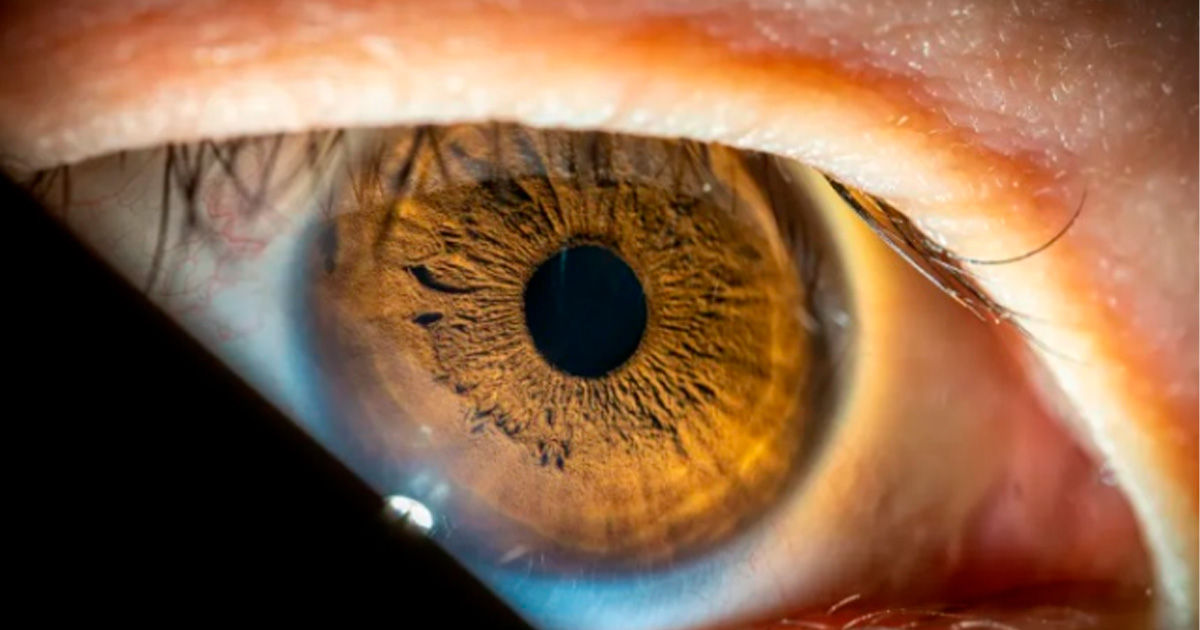 Cirurgia única para tratar glaucoma e catarata será oferecida pelo SUS